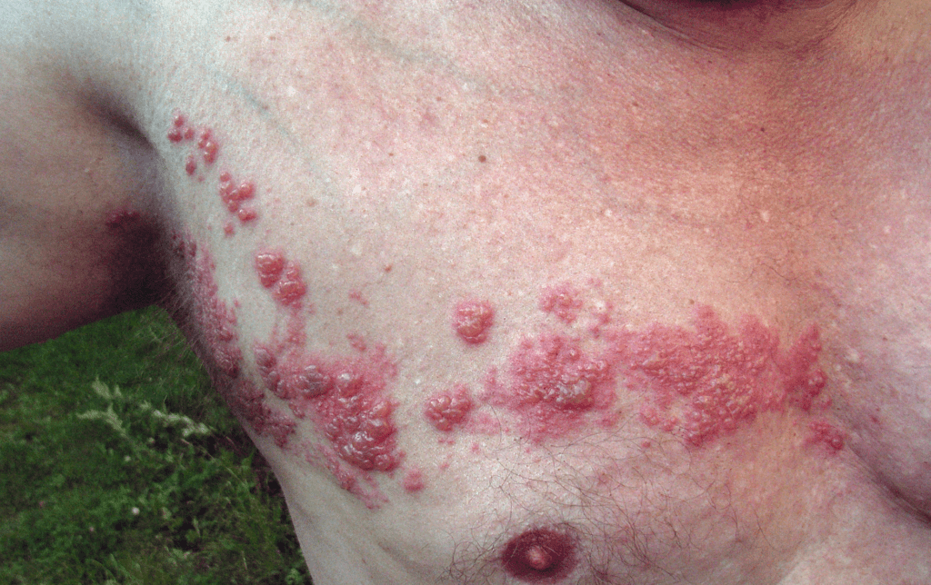 Herpes zoster chest at wikimedia commons